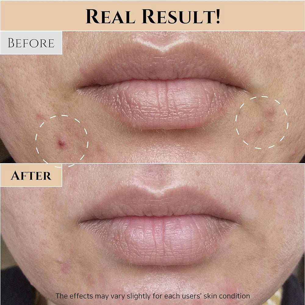 Before and after comparison of a person's lips with visible skin improvement.